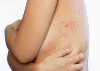 Best Herpes Supplements for Natural Outbreak Prevention Support
