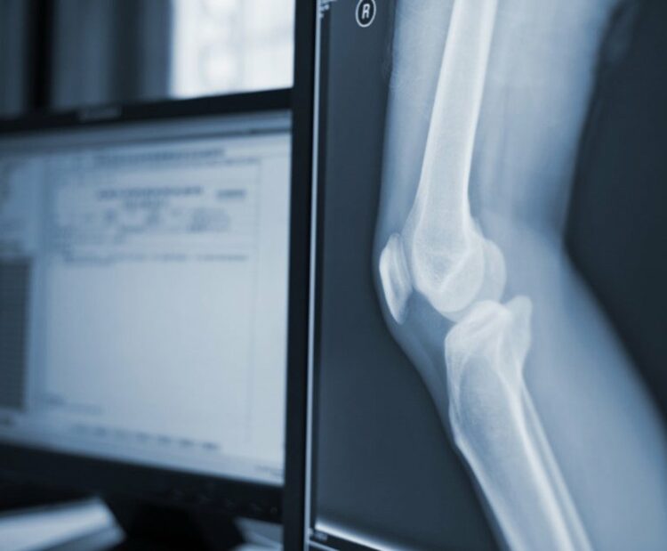 New Litigation Alert: Zimmer Biomet, Maker of Knee Replacement Device, Sued Following Implant Recall