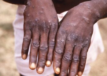 monkeypox-spreads-in-west,-baffling-african-scientists