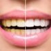 types-of-teeth-whitening-at-home-and-at-the-dentist