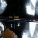 fda-now-requires-new-info-on-breast-density-with-all-mammograms