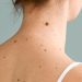 do-your-moles-ever-go-away?