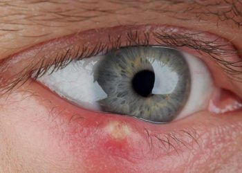 how-to-get-rid-of-a-stye-in-your-eye