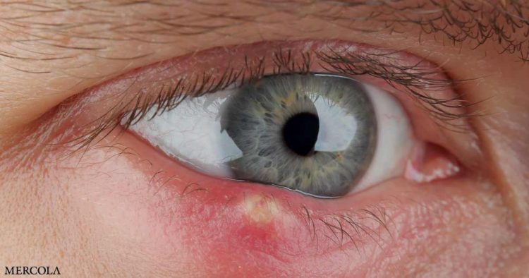 how-to-get-rid-of-a-stye-in-your-eye