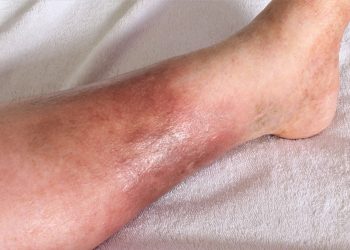 understanding-the-signs-of-deep-vein-thrombosis