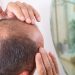 6-best-fixes-for-fighting-hair-loss-and-winning