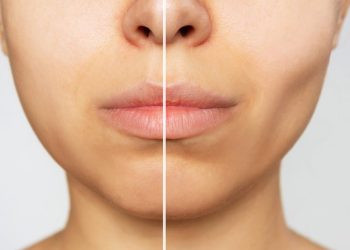 ‘ozempic-face’-—-a-troubling-side-effect-of-weight-loss-drugs