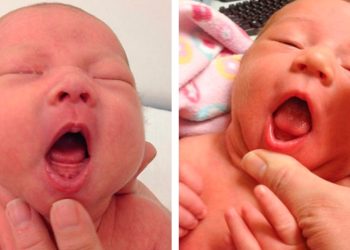 tongue-tie-may-be-overdiagnosed-in-babies