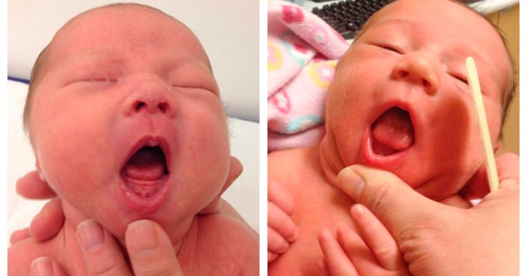 tongue-tie-may-be-overdiagnosed-in-babies