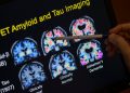 blood-tests-for-alzheimer’s-may-be-coming-to-your-doctor’s-office