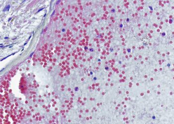 mpox-is-officially-a-health-emergency-in-africa
