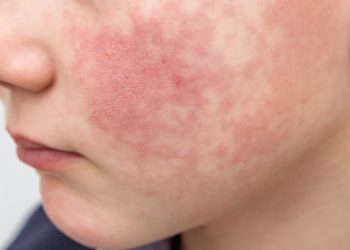 what-to-know-about-parvovirus-b19,-a-respiratory-virus-on-the-rise