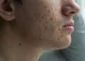 Acne affects millions and mental health, experts say early treatment is key