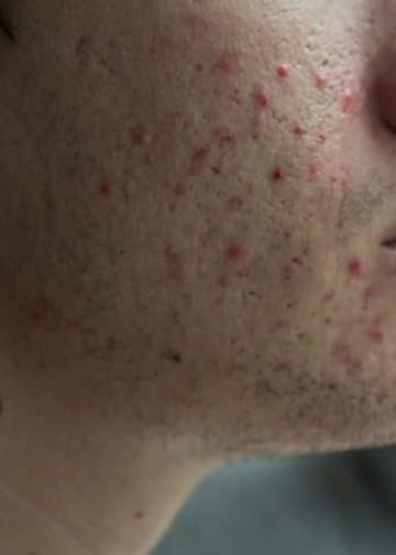 Acne affects millions and mental health, experts say early treatment is key