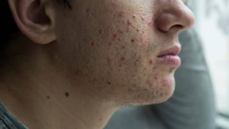 Acne affects millions and mental health, experts say early treatment is key