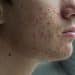 Acne affects millions and mental health, experts say early treatment is key
